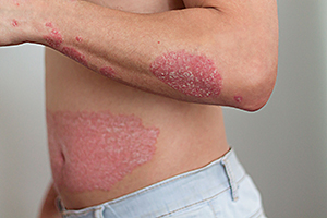 skin diseases
